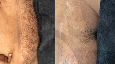 Brazilian Wax vs Sugaring: Which Hair Removal Method Is Right For You?
