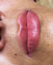 preenchimento labial