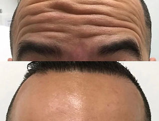 Toxina Botulínica