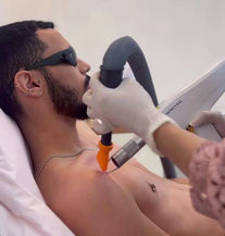 remoção de tatuagem no corpo