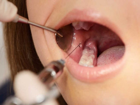 Thuốc tê nhổ răng khôn hết tác dụng trong bao lâu?