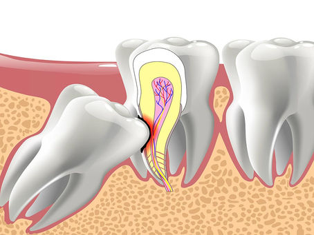 Nhổ răng khôn có ảnh hưởng đến thần kinh không? Khi nào cần nhổ ngay để bảo vệ sức khỏe?