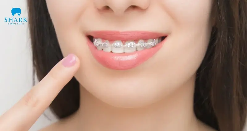 Niềng răng mắc cài sứ