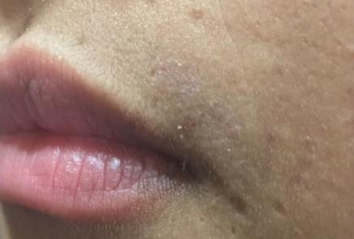 Laser Hair Removal | GLOWAESTHETICS MEDICAL SPA + BEAUTY BOUTIQUE