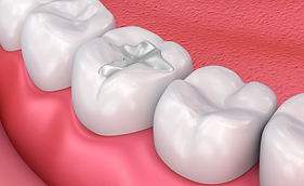 When Do You Need a Tooth Filling