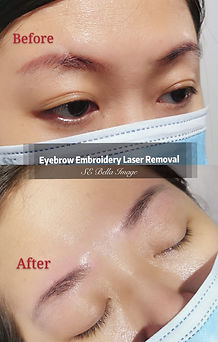 Eyebrow laser remove_edited.jpg