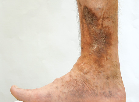 Human skin disease. Person s foot that is affected by dermatological skin disease with sca