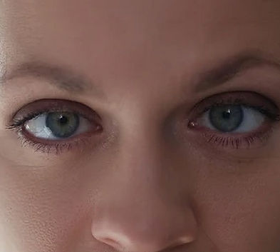 Woman with lazy eyes