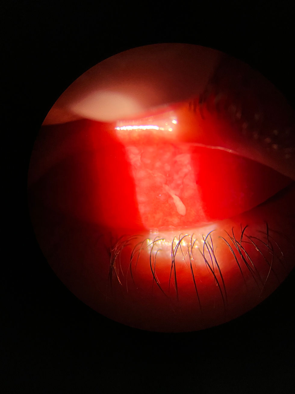 Significant allergic conjunctivitis resulting in itchy eyes and mucous debris on the eye