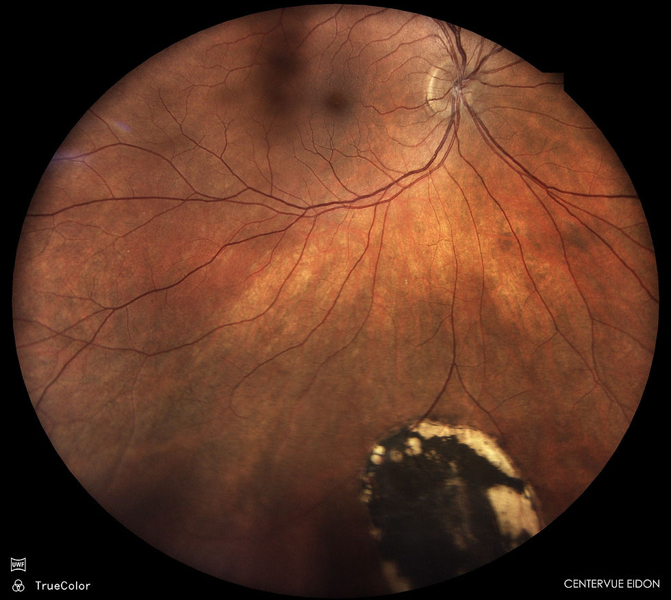 Benign pigmented finding in the retina called a CHRPE