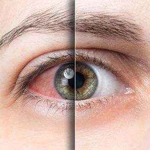 Understanding Dry Eye Treatments: Which Option is Right for You?