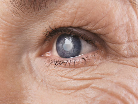 Glaucoma Explained: Symptoms, Risks & Why Early Detection Saves Vision