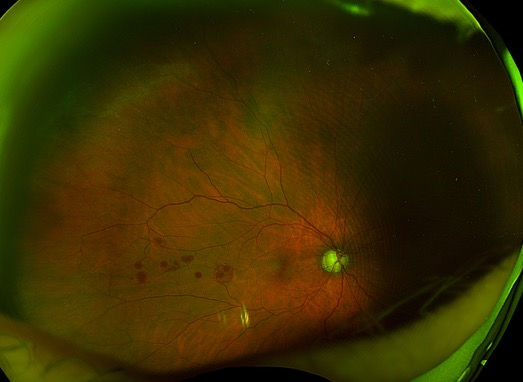 Retinal hemorrhages in a patient having cancer radiation treatment