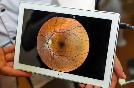Retinal scan on a tablet for glaucoma management in Daly City