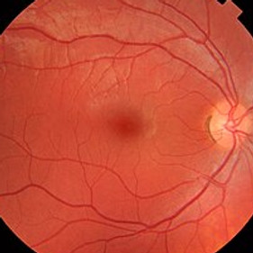 Fundus_photograph_of_normal_right_eye.jpg