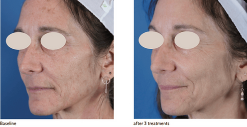 OptiLight Photorejuvenation (1)_edited_edited.png