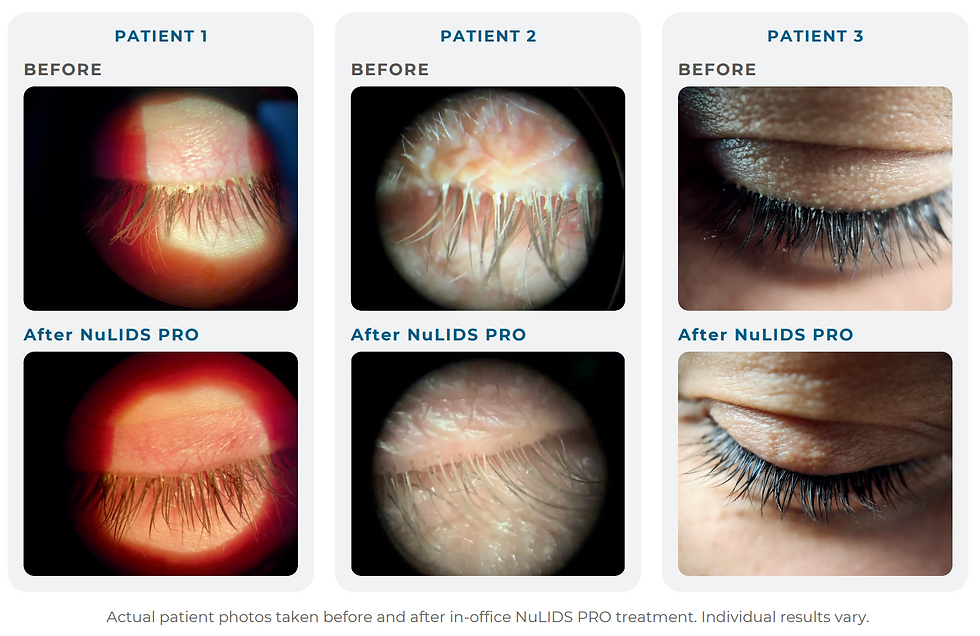Three before-and-after eyelid close-ups labeled Patient 1-3, showing NuLIDS PRO lash results on a white infographic.
