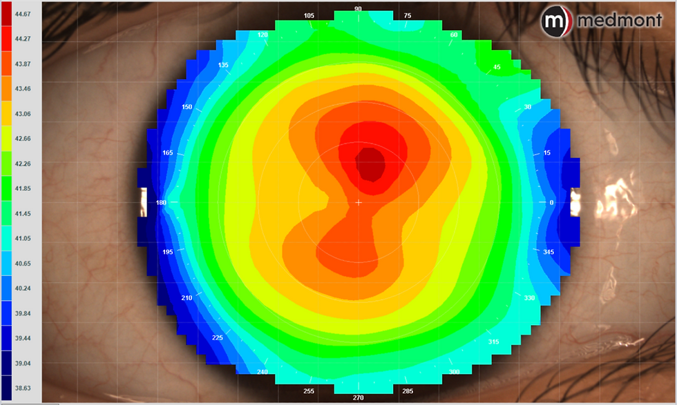 Figure 1: In this Axial power map display of a patient with regular corneal astigmatism, note the symmetry of power when comparing hemispheres. Based on the anterior surface shape, this patient should achieve a high level of visual acuity with most vision correction modalities.