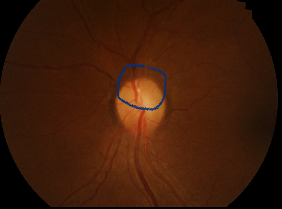 Plaque found in a retinal artery resulting in permanent partial vision loss