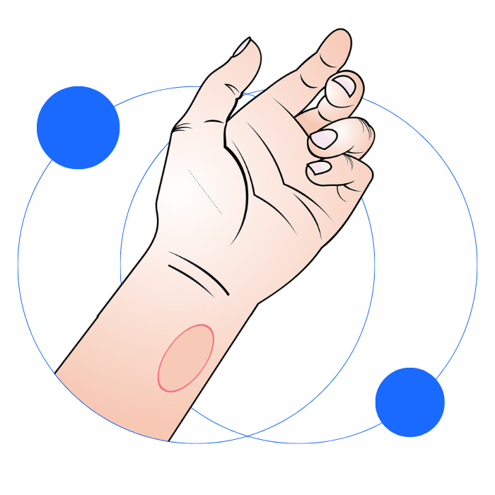 Skin flap transplant.png