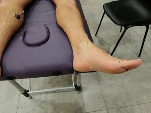 Les Bienfaits de l'Acupuncture, Ventouses et Moxibustion pour Votre Santé