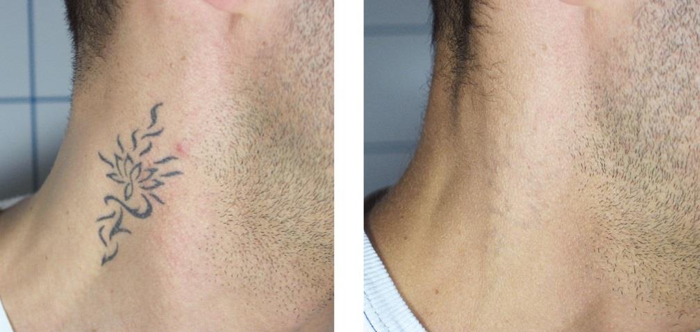 Medicina Estetica Verbania Rimozione Tatuaggi Laser Q Swithed