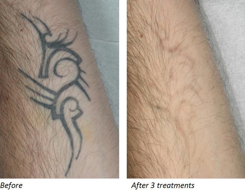 Medicina Estetica Verbania Rimozione Tatuaggi Laser Q Swithed