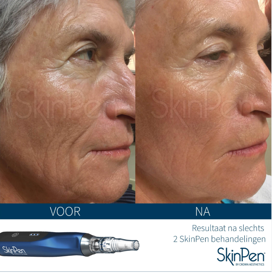 Wrinkle reduction using skin pen