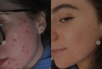 Treat acne scarring in Norwich with IPL Laser at Danielle Mae Cosmetics, Norwich