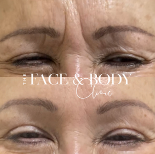 Anti-wrinkle injections