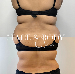 Fat Freezing & Fat Cavitation Combo