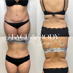 Cryolipolysis fat freezing