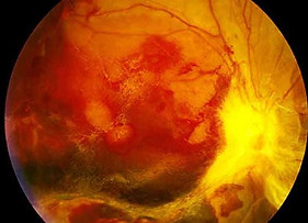 DiabeticRetinopathy-8.jpg