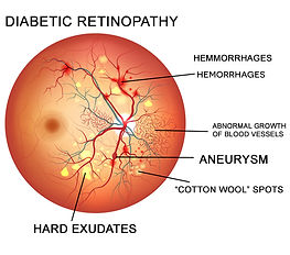 diabetic-retinopathy.jpg
