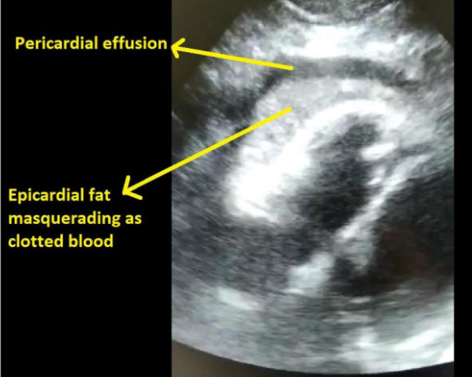 Subcostal view of the heart showing the epicardial fat and pericardial effusion