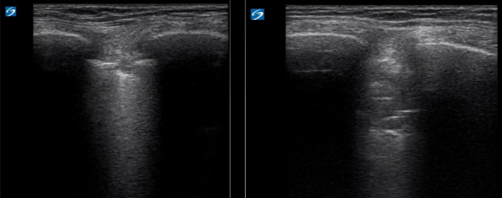 Right chest subpleural changes
Right chest air bronchograms on POCUS