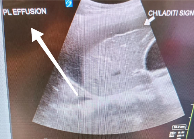 Sonographic Demonstration of Chilaiditi Sign in an Elderly Patient with Respiratory Distress and Abdominal Pain