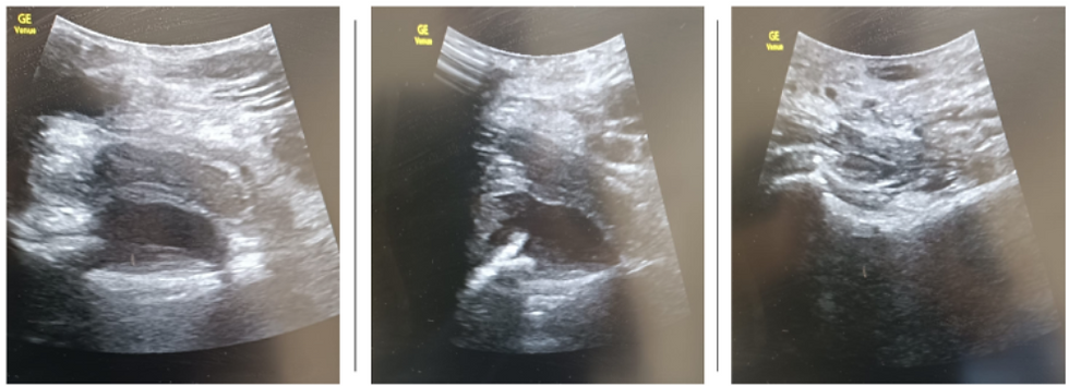 Right hip transverse view: Demonstrates effusion
Right hip longitudinal view: Demonstrates effusion
Left hip longitudinal view: No effusion