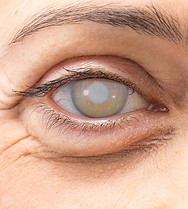 Picture of an eye with a cataract
