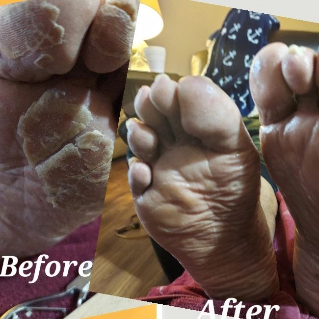 Before dry skin and calluses build up. After care from Beautiful Sole moisturized skin calluses reduced and smooth skin.