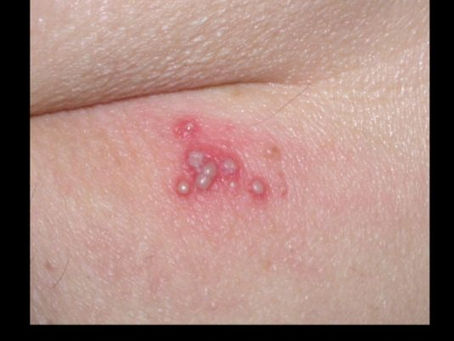 Comment se débarrasser d'un ZONA naturellement ?