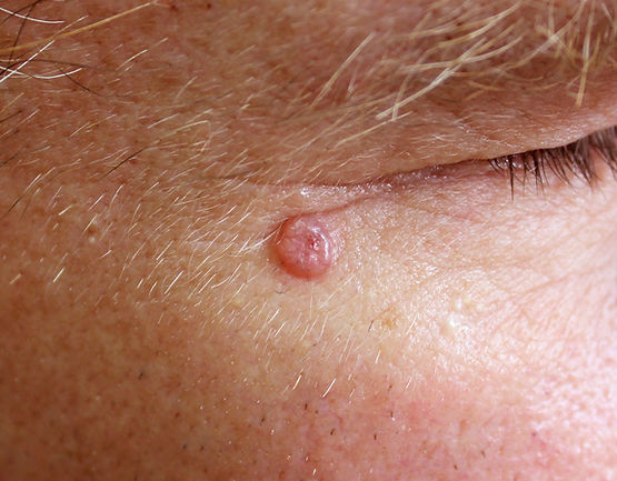 A case of nodular basal cell carcinoma.jpg