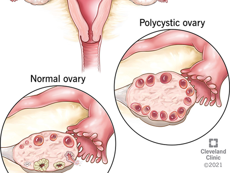 Polycystic Ovarian Syndrome (PCOS)