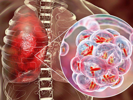 Datos básicos sobre la tuberculosis