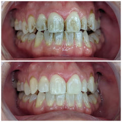Follow us for before and after smiles and giveaways. There is a lot of heavy black dental staining in the first picture and then bright white clean teeth in the second picture. A great happy and satisfied smile.
