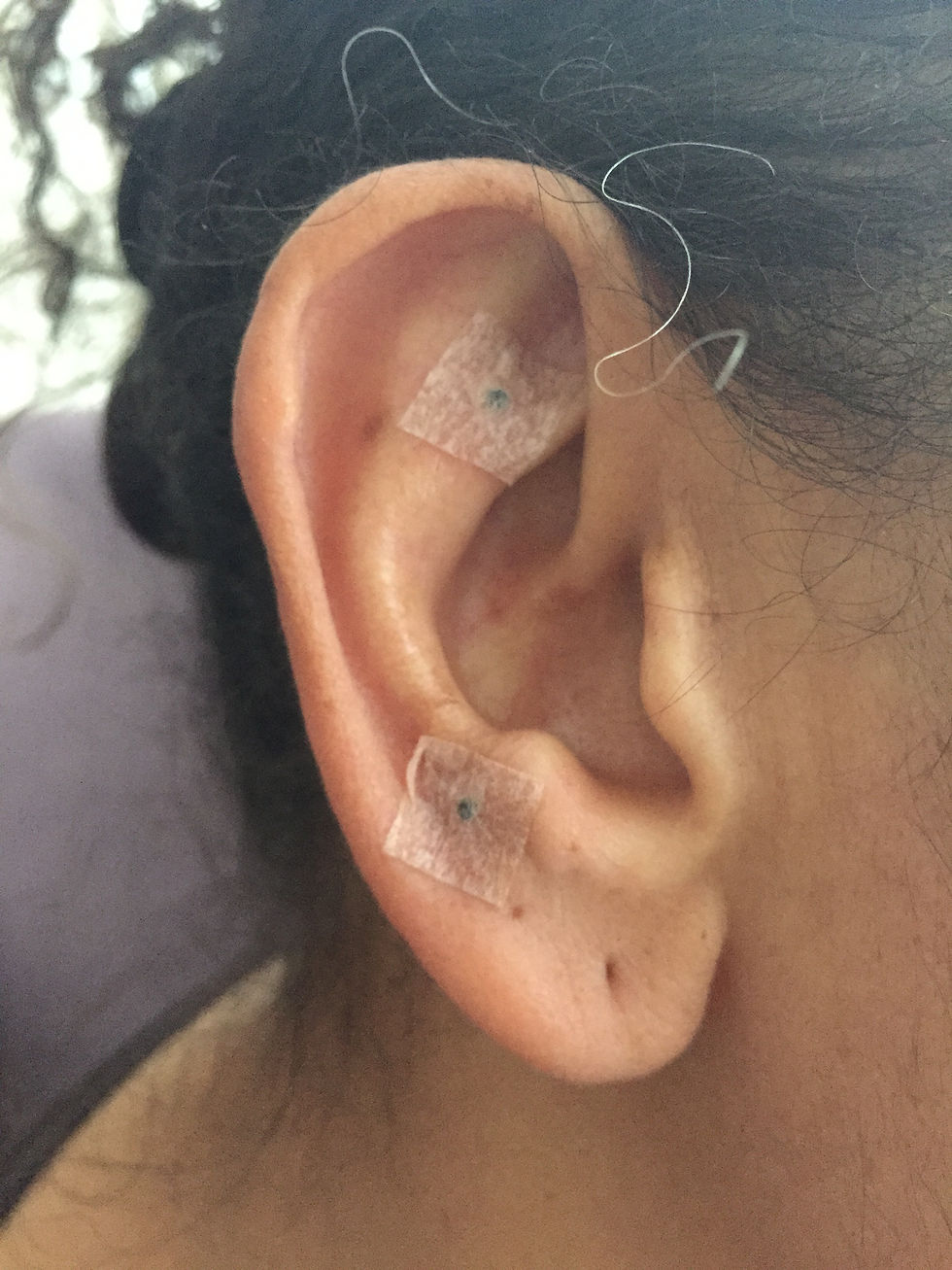 Vaccaria seeds applied to occiput and shenmen acupoints for continued benefit post treatme