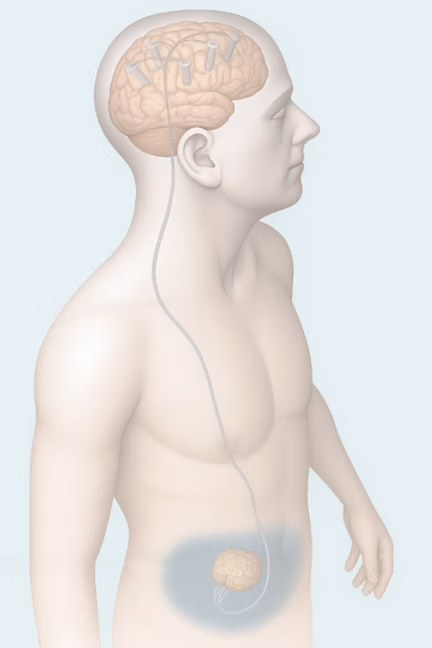 Extending the brain beyond the skull to peritoneal constructs. Living electrodes implanted into the cerebral cortex through 0.8 mm burr holes with axon bundles that converge and link reciprocally to neural constructs in the peritoneum. Optionally, electrode, optical, ultrasonic transducer and other arrays can thus be placed in the more spacious peritoneum. © 2025, Mijail D. Serruya.