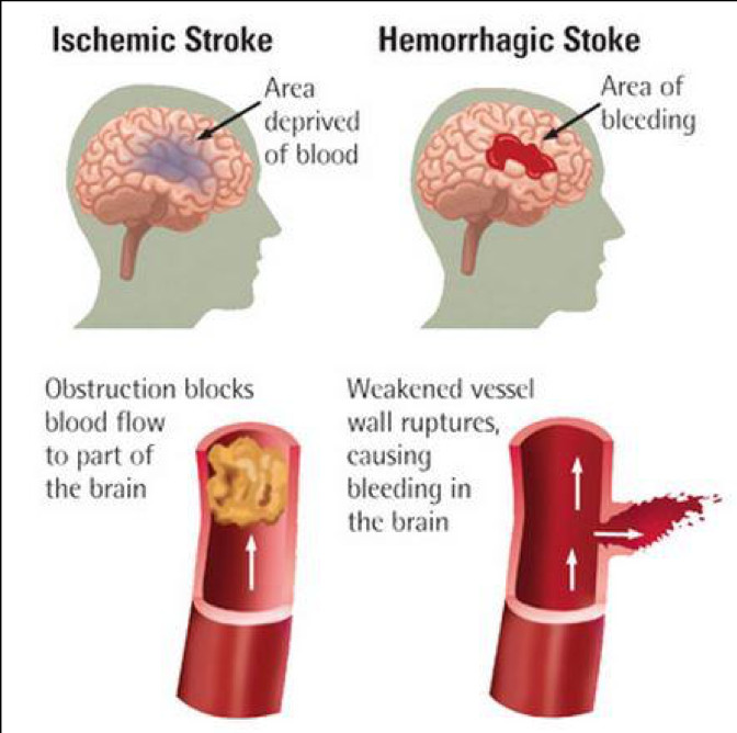 The types of stroke - ischaemic and haemorrhagic
