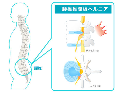 椎間板ヘルニアのつらい痛み・しびれに悩む方へ｜原因と根本改善のための考え方