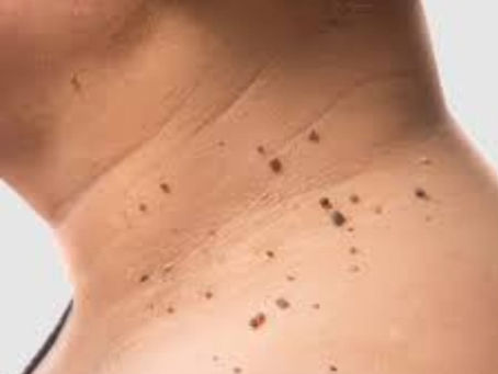 טיפול בסרחי עור